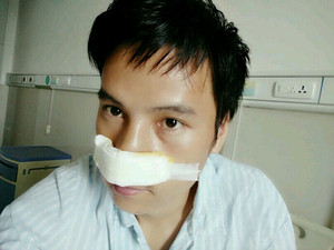 記錄了隆鼻整形（膨體隆鼻+鼻翼縮?。┦中g前后的過程，還有對比照片哦