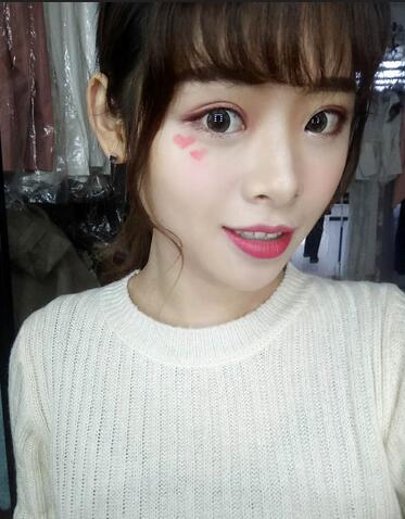 北京熙朵全切雙眼皮1個月恢復(fù)日記