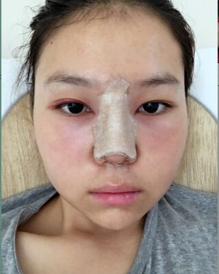 做隆鼻整形的親身日記，氣質(zhì)完全不一樣了