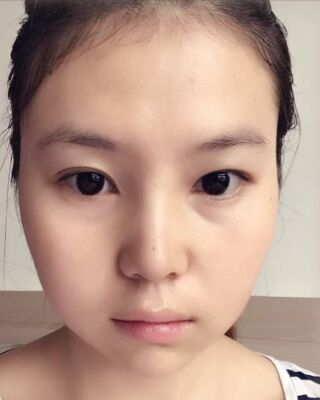 做隆鼻整形的親身日記，氣質(zhì)完全不一樣了