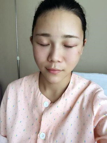 我的自體脂肪豐額頭+豐臉頰+雙眼皮+開眼角的真實(shí)經(jīng)歷 還有果圖哦