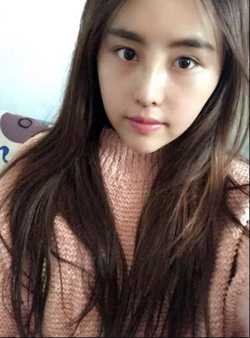 我在南昌佳美做的隆鼻整形+光纖溶脂去雙下巴 果真的很不錯(cuò)