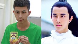 于朦朧墊下巴手術前后對比圖