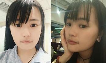 下巴整形前后對比圖