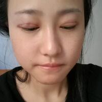 割雙眼皮恢復(fù)過程分享，整形價格3800元