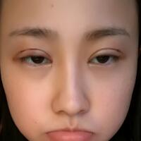 割雙眼皮恢復(fù)過程分享，整形價格3800元