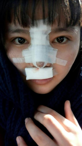 隆鼻整形手術(shù)后  我的高鼻梁養(yǎng)成記 內(nèi)有果對(duì)比圖