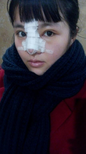 隆鼻整形手術(shù)后  我的高鼻梁養(yǎng)成記 內(nèi)有果對(duì)比圖