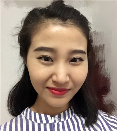 玻尿酸注射隆鼻前后對比果圖片分享，大同美神賈文醫(yī)生做的~