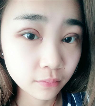 開內(nèi)眼角+切開雙眼皮前后對比果圖片分享，青島金島韓勝醫(yī)生做的~