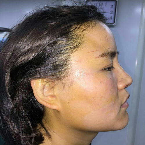 自體軟骨移植隆鼻恢復(fù)過程和前后對比果照片分享，張海明做的~