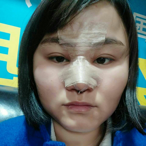 自體軟骨移植隆鼻恢復(fù)過程和前后對比果照片分享，張海明做的~