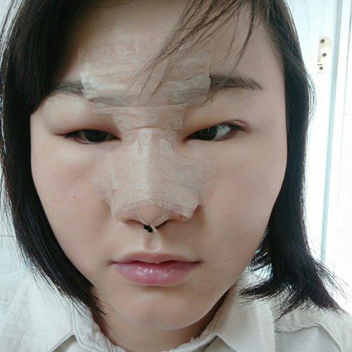 自體軟骨移植隆鼻恢復(fù)過程和前后對比果照片分享，張海明做的~