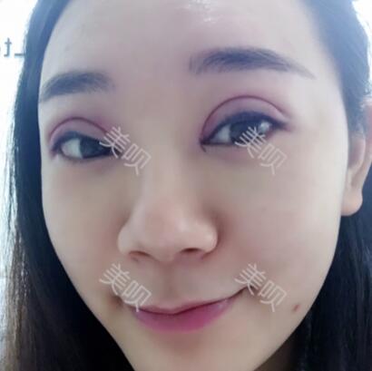 埋線雙眼皮我從內(nèi)雙的小眼睛變成大眼睛電眼了