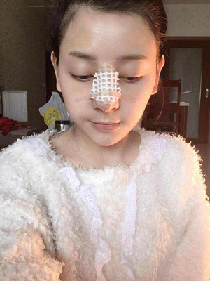 自體軟骨隆鼻手術(shù)前后過程以及對比照片分享