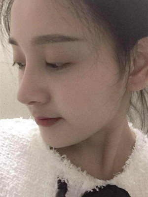 自體軟骨隆鼻手術(shù)前后過程以及對比照片分享