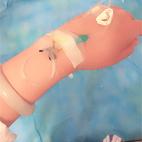 大腿抽脂手術(shù)后，還我小細(xì)腿!還有對比照片喲!