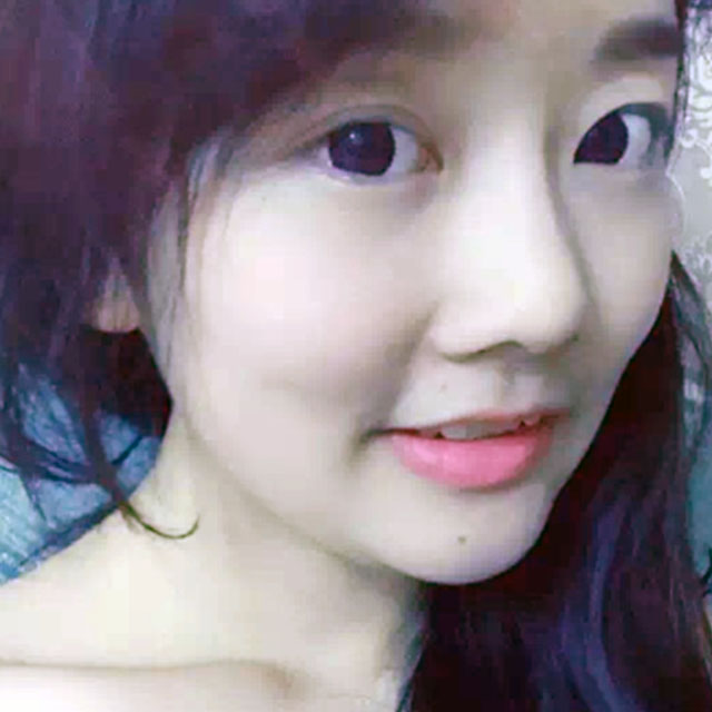 自體軟骨隆鼻恢復(fù)過程照片分享，還有前后對(duì)比果可以看哦~