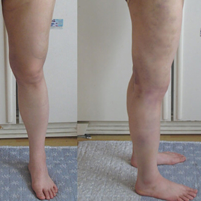 水動力吸脂瘦腰腹真實案例分享，還有前后對比果圖片哦~