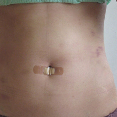 水動力吸脂瘦腰腹真實案例分享，還有前后對比果圖片哦~