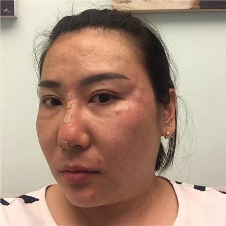 注射注射瘦臉去魚尾紋前后對(duì)比果照片分享，大同清木姜際珠做的~