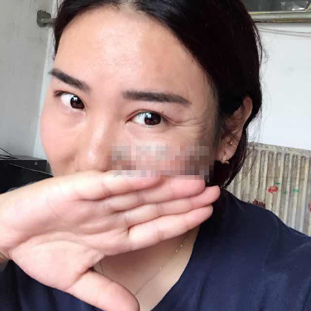 注射注射瘦臉去魚尾紋前后對(duì)比果照片分享，大同清木姜際珠做的~