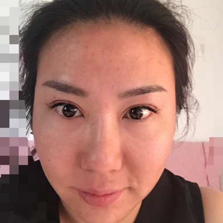 注射注射瘦臉去魚尾紋前后對(duì)比果照片分享，大同清木姜際珠做的~