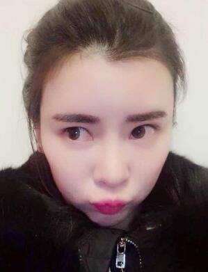 自體脂肪填充太陽(yáng)穴