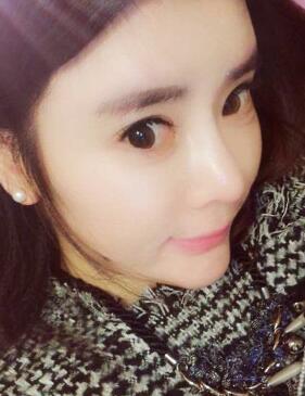 自體脂肪豐太陽(yáng)穴兩個(gè)半月