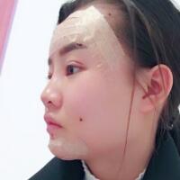 自體脂肪面部填充恢復(fù)過(guò)程分享，填充價(jià)格12000元