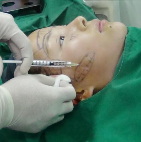 自體脂肪面部填充后我不再依賴p圖軟件了