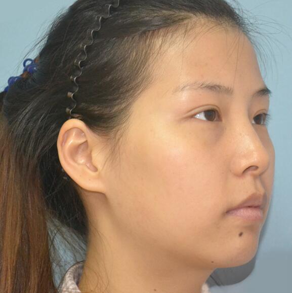 自體脂肪面部填充后我不再依賴p圖軟件了