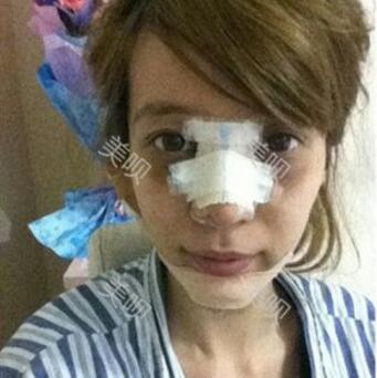 我的自體脂肪隆鼻+墊下巴恢復(fù)過程