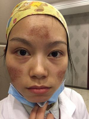 點陣激光祛痘前后過程對比照片分享，大家來看看果怎么樣