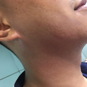 高強度聚焦超聲除掉小細紋，不再是女人的專*，我也可以擁有!!!