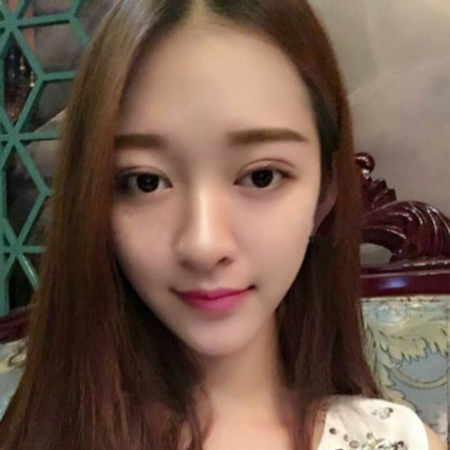 切開雙眼皮一個月了，分享恢復(fù)過程和前后對比果照片哦~