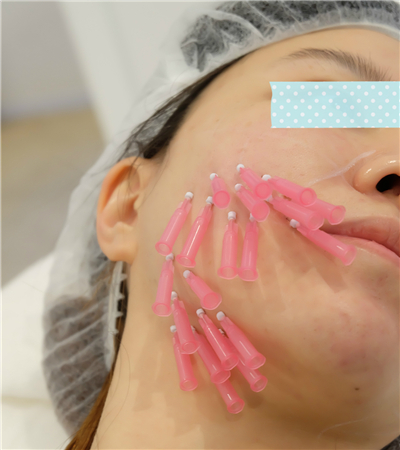 面部埋埋蛋白線.提升術(shù)后恢復(fù)過程分享，還有前后對比果照片哦~