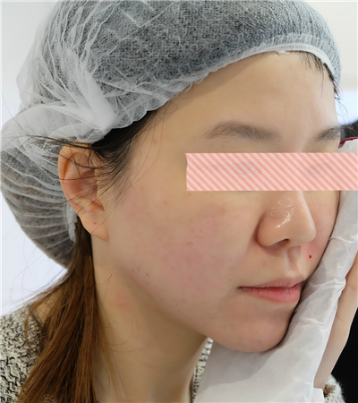 面部埋埋蛋白線.提升術(shù)后恢復(fù)過程分享，還有前后對比果照片哦~