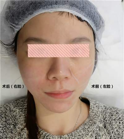 面部埋埋蛋白線.提升術(shù)后恢復(fù)過程分享，還有前后對比果照片哦~