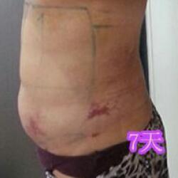 肚子減肥的方法就是吸脂減肥瘦腰腹了，親身經(jīng)歷分享