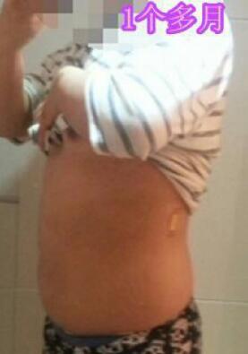吸脂減肥瘦腰腹術(shù)后一個(gè)多月恢復(fù)果