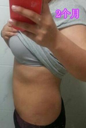 吸脂減肥2個(gè)多月了，果很滿意