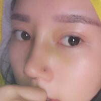 鼻子整形價格10000元，隆鼻手術(shù)過程圖分享