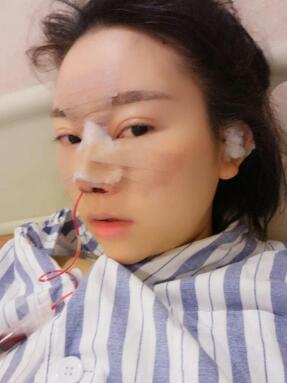 鼻子整形手術(shù)過后