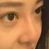 為什么大家覺得隆鼻恐怖，我就做了玻尿酸隆鼻，過程經(jīng)歷分享