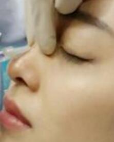 玻尿酸隆鼻手術分享