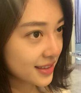 玻尿酸隆鼻手術下臺后的照片