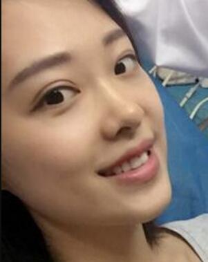 玻尿酸隆鼻手術