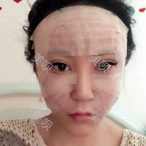 自體脂肪豐蘋果肌后我凹陷顯老的面部終于變得年輕啦