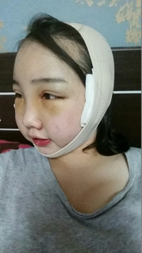 顴骨整形手術(shù)后，我也可以擁有精致小臉了